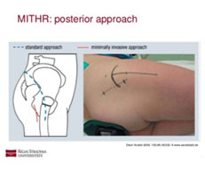 Anterior Hip Replacement vs. Mini-Posterior Hip Replacement - Las Vegas  Total Knee & Hip Surgeon