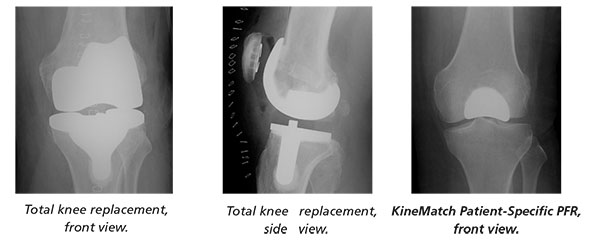 partial knee replacement with a KineMatch® Patient-Specific PFR